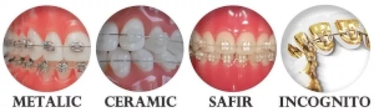 Amplasarea aparatului dentar astfel incat sa nu se vada, metoda ce se adreseaza mai ales adultilor cu o viata sociala si profesionala intensa